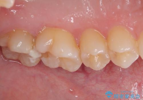 奥歯のむし歯が痛い セラミックによるむし歯治療の治療前