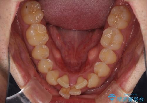飛び出した前歯を治したい　ワイヤー装置での抜歯矯正の治療前