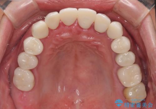 受け口傾向の咬み合わせを治したい 全顎セラミック治療の治療後