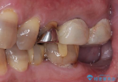 インプラント治療を含む精密審美治療の治療前