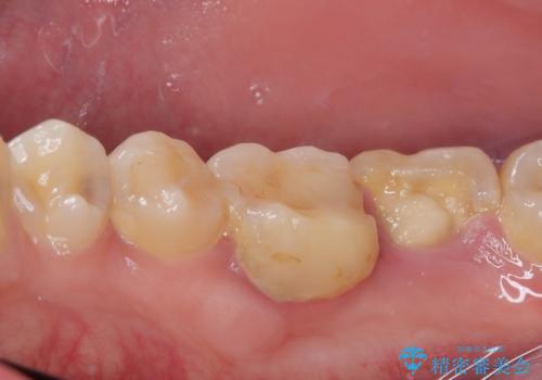 大きく歯が欠けた。 外科処置を行ったセラミック治療の治療前