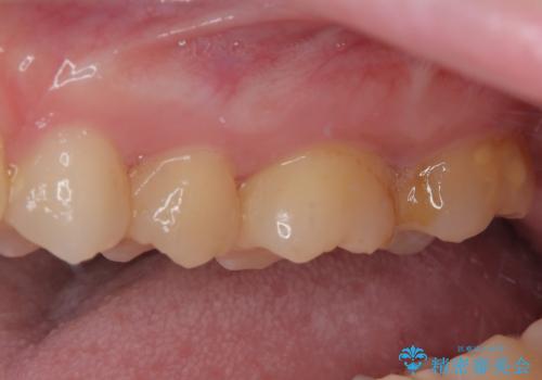 奥歯のむし歯が痛い セラミックによるむし歯治療の治療前