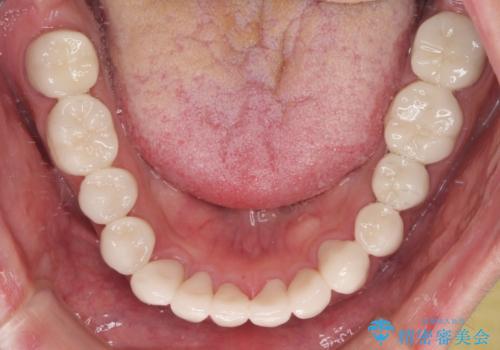 受け口傾向の咬み合わせを治したい 全顎セラミック治療の治療後
