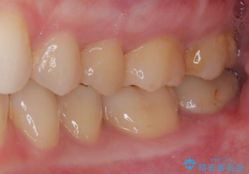 奥歯のむし歯が痛い セラミックによるむし歯治療の治療前