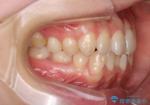 右下5番の先天欠如と前歯の叢生に対するワイヤー矯正とインプラント治療の治療前