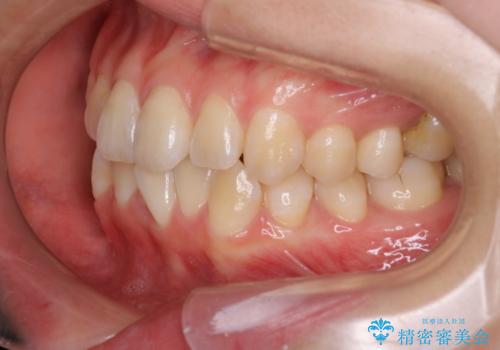 右下5番の先天欠如と前歯の叢生に対するワイヤー矯正とインプラント治療の治療前
