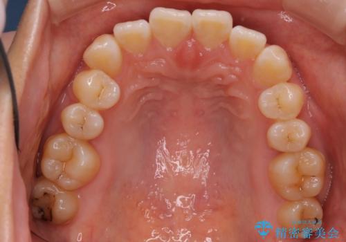 右下5番の先天欠如と前歯の叢生に対するワイヤー矯正とインプラント治療の治療前