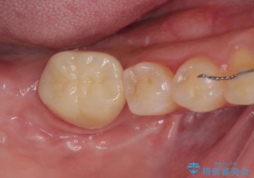 隙間の空いた奥歯 オールセラミッククラウンの補綴治療の症例 治療後
