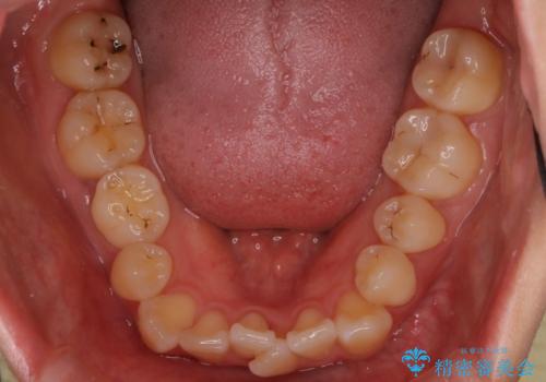 右下5番の先天欠如と前歯の叢生に対するワイヤー矯正とインプラント治療の治療前