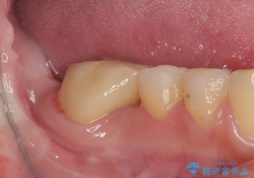 隙間の空いた奥歯 オールセラミッククラウンの補綴治療の治療後