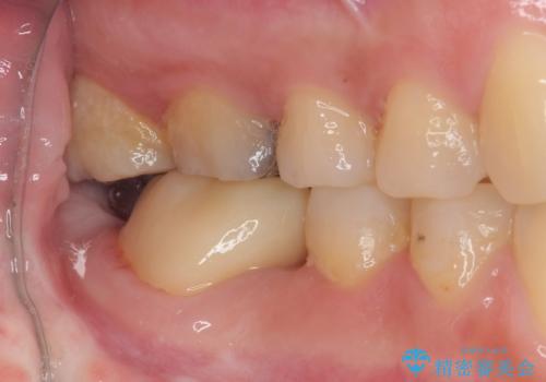 隙間の空いた奥歯 オールセラミッククラウンの補綴治療の治療後
