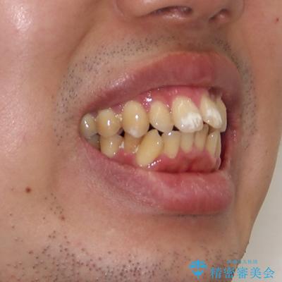 口が閉じられない 抜歯矯正で前歯の突出感を改善の治療前(顔貌)