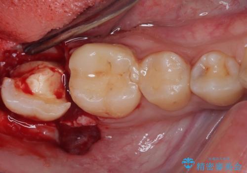 大きく歯が欠けた。 外科処置を行ったセラミック治療の治療中