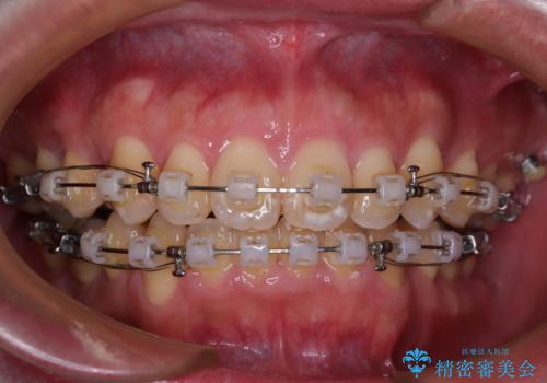 口が閉じられない 抜歯矯正で前歯の突出感を改善の治療中