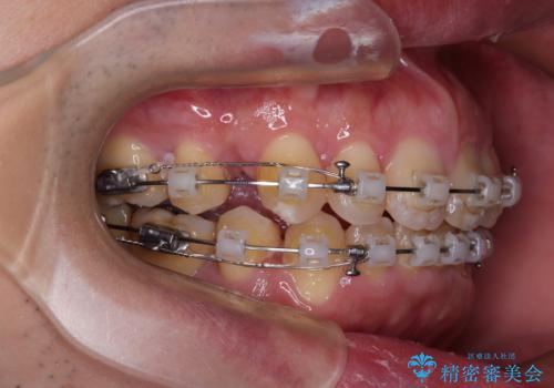 口が閉じられない 抜歯矯正で前歯の突出感を改善の治療中