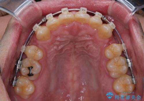 口が閉じられない 抜歯矯正で前歯の突出感を改善の治療中