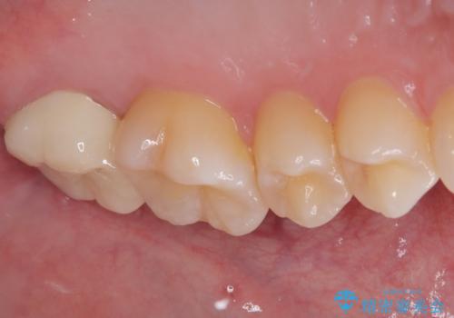 奥歯のむし歯が痛い セラミックによるむし歯治療の治療後