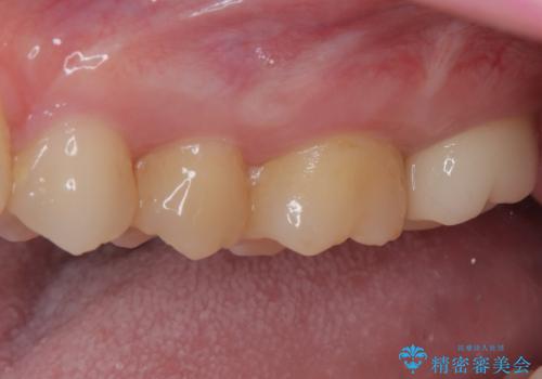 奥歯のむし歯が痛い セラミックによるむし歯治療の治療後