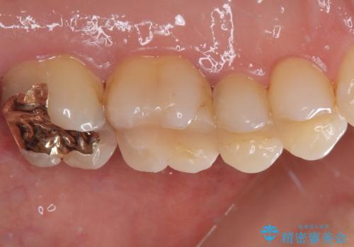 冷たいものがしみる ゴールドを用いた奥歯のむし歯治療の治療後