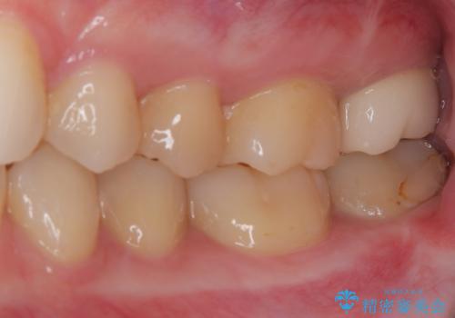 奥歯のむし歯が痛い セラミックによるむし歯治療の治療後