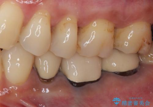 冷たいものがしみる ゴールドを用いた奥歯のむし歯治療の治療後