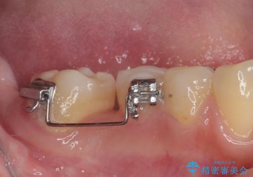 隙間の空いた奥歯 オールセラミッククラウンの補綴治療の治療前