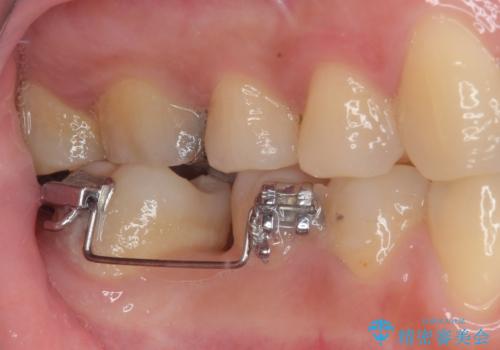 隙間の空いた奥歯 オールセラミッククラウンの補綴治療の治療前