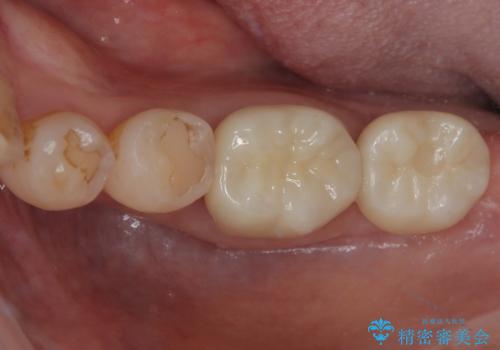 骨よりも深く進行したむし歯 即時荷重インプラントでの短期間治療の症例 治療後