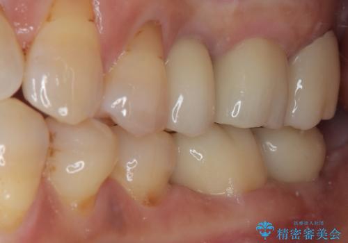 骨よりも深く進行したむし歯 即時荷重インプラントでの短期間治療の治療後