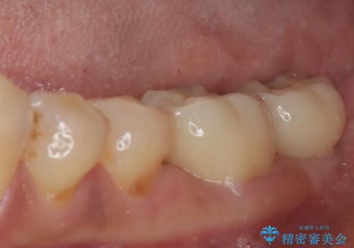 骨よりも深く進行したむし歯 即時荷重インプラントでの短期間治療の治療後