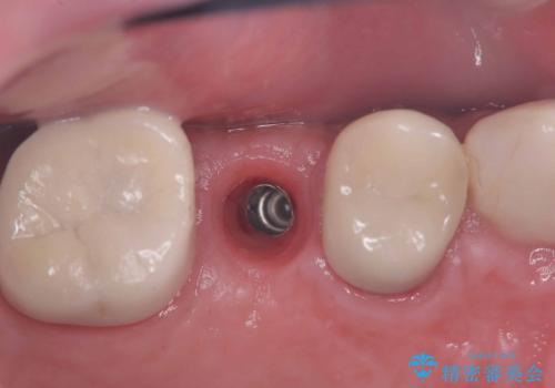 痛く無いインプラント治療!|残根状態の治療の治療中