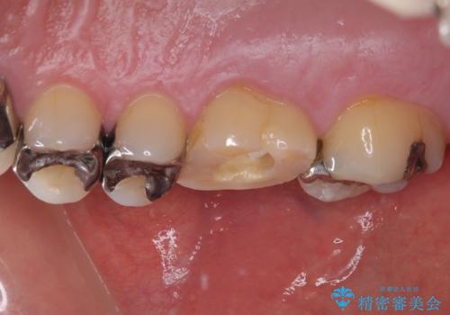 治療途中の奥歯 オールセラミッククラウンでのむし歯治療の治療前