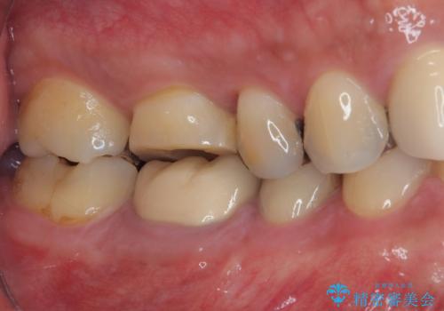 治療途中の奥歯 オールセラミッククラウンでのむし歯治療の治療前