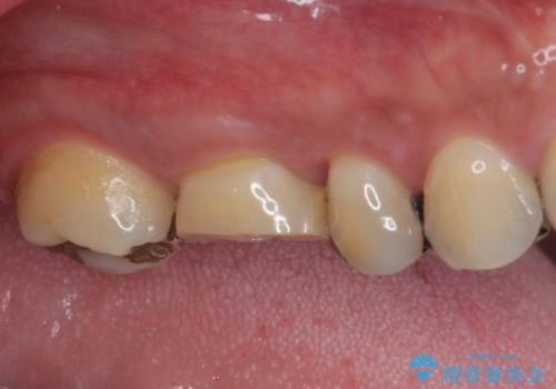 治療途中の奥歯 オールセラミッククラウンでのむし歯治療の治療前