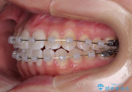 捻れた前歯を楽して改善 ワイヤー装置での非抜歯矯正の治療中