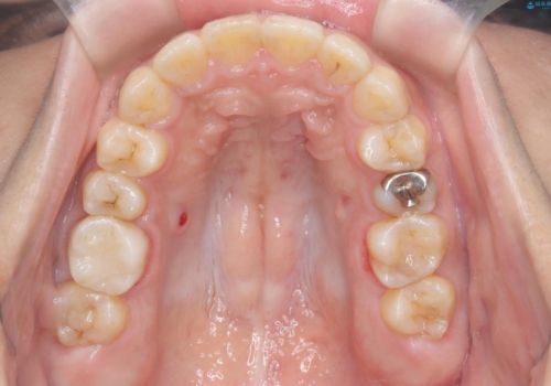 【ワイヤー矯正】前歯の凸凹を治したいの治療後