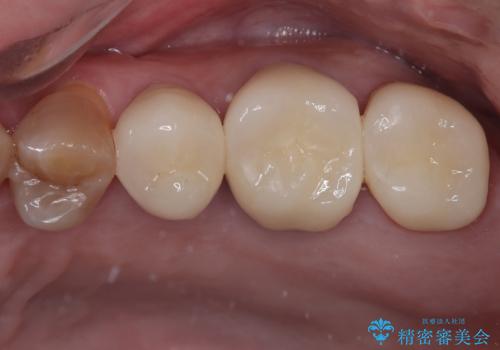 インプラント治療を含む精密審美治療の症例 治療後