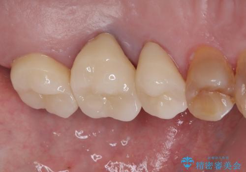 インプラント治療を含む精密審美治療の治療後