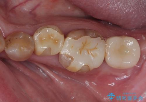 インプラント治療を含む精密審美治療の治療後