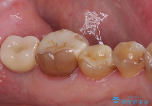 インプラント治療を含む精密審美治療の治療後