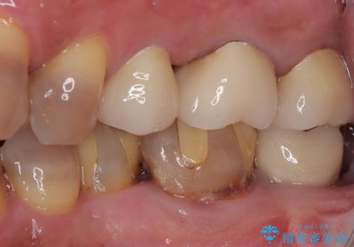 インプラント治療を含む精密審美治療の治療後