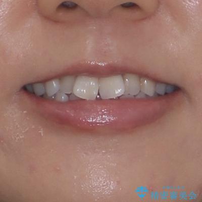 捻れた前歯を楽して改善 ワイヤー装置での非抜歯矯正の治療前(顔貌)