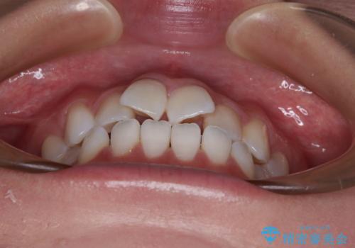 捻れた前歯を楽して改善 ワイヤー装置での非抜歯矯正の治療前