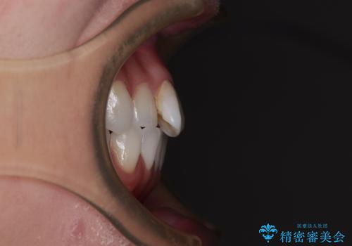 捻れた前歯を楽して改善 ワイヤー装置での非抜歯矯正の治療前