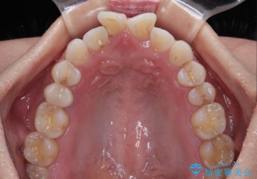 捻れた前歯を楽して改善 ワイヤー装置での非抜歯矯正の治療前