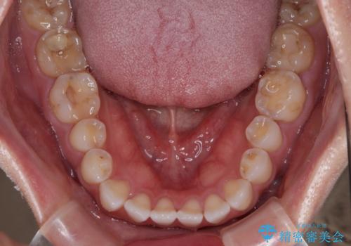 捻れた前歯を楽して改善 ワイヤー装置での非抜歯矯正の治療前