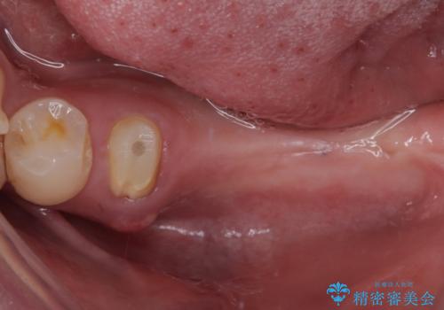 放置していたむし歯 抜歯即時埋入インプラントによる補綴治療の治療前
