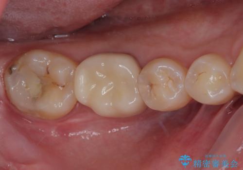 歯茎が腫れている 奥歯の根管治療の治療後