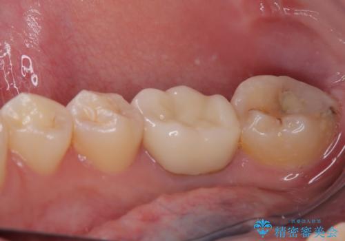 歯茎が腫れている 奥歯の根管治療の治療後