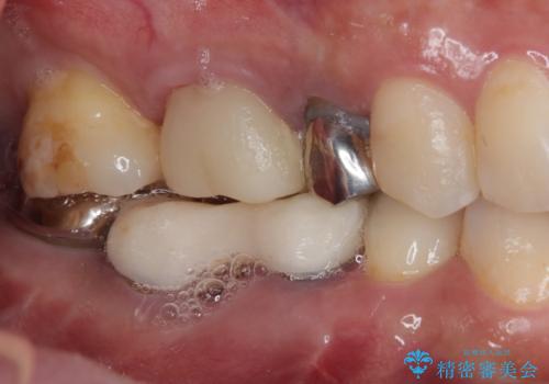 放置していたむし歯 抜歯即時埋入インプラントによる補綴治療の治療前